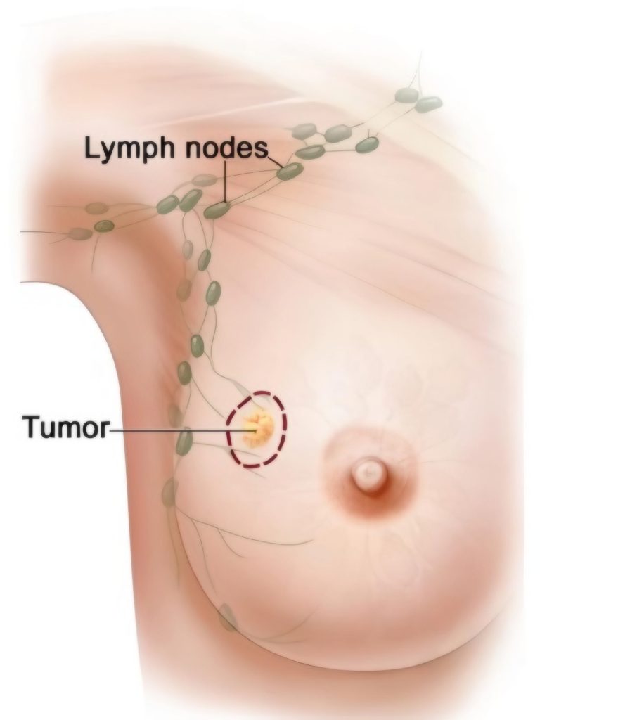 breast Cancer