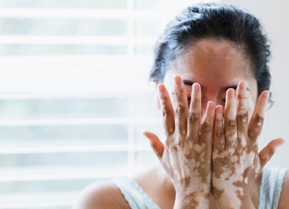a person with vitiligo