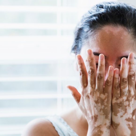 a person with vitiligo