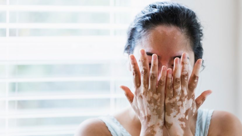 a person with vitiligo