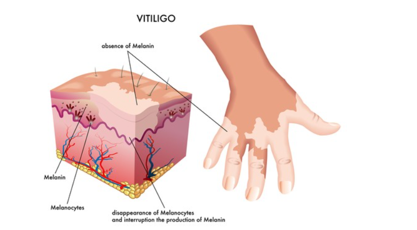 Cause of Vitiligo