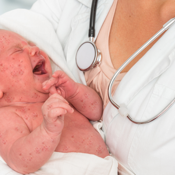 Herpes in Newborns
