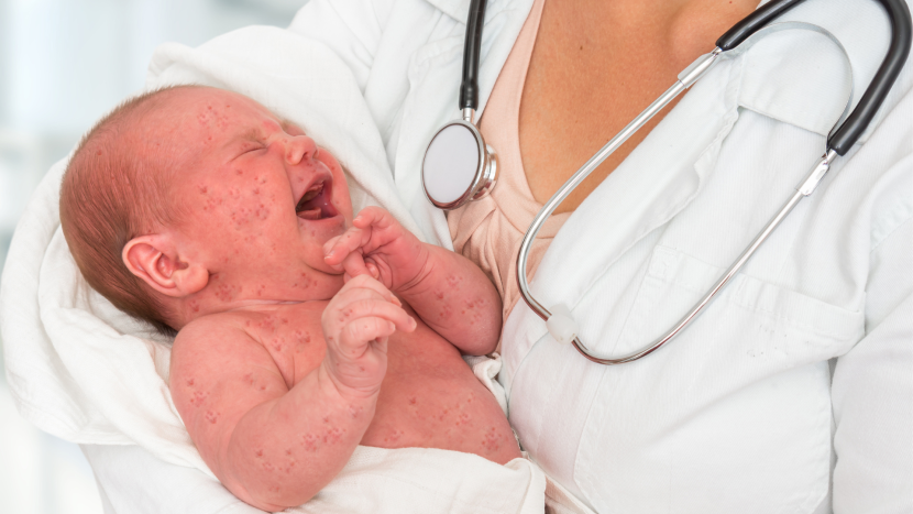 When a Kiss Turns Deadly: The Danger of Oral Herpes to Newborns Herpes in Newborns