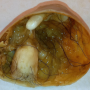 Teratoma Tumor