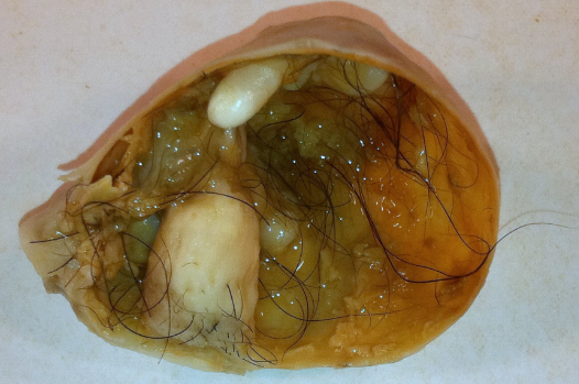 Teratoma Tumor