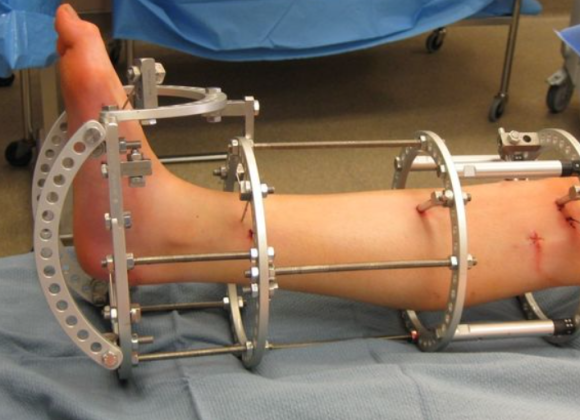 limb lengthening surgery