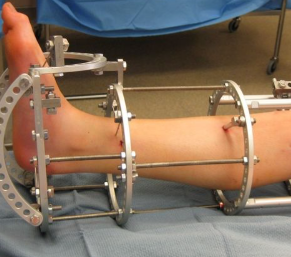 limb lengthening surgery