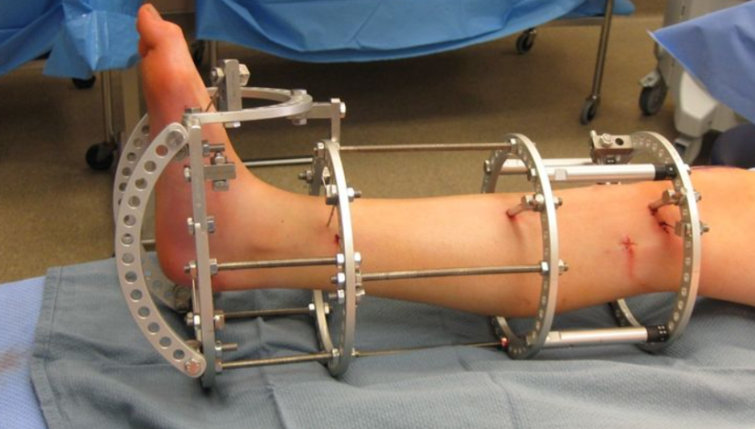 Limb Lengthening Surgery Recovery: Timeline, Pain, and Physical Therapy limb lengthening surgery