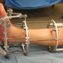 limb lengthening surgery