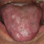 lichen planus on tongue