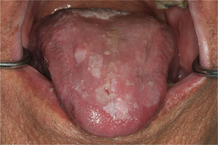 lichen planus on tongue